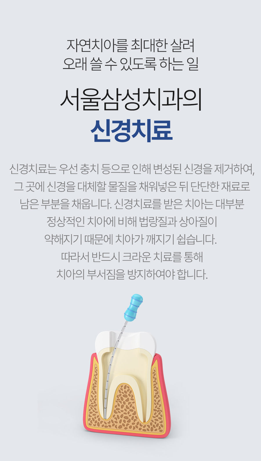 서울삼성치과 신경치료 안내